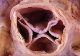 1c Tricuspid Bicuspid Unicuspid Quadricuspid Valve