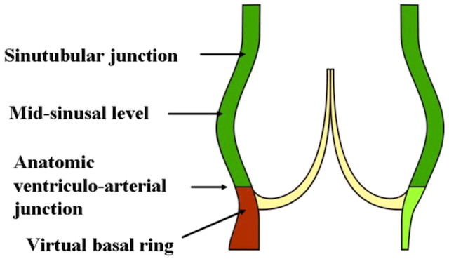 Free Margin Adjacent Leaflets