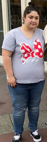 Before image of weight loss surgery